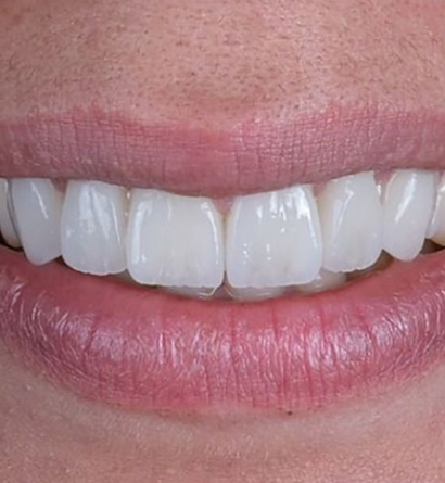 Best Teeth Retainers in Dubai