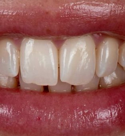 Best Teeth Retainers