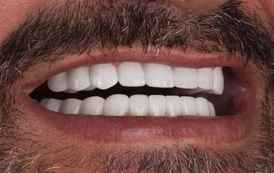 Best Tooth Extraction Dubai