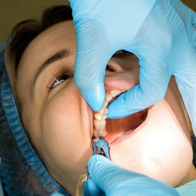 Best Tooth Removal in Dubai - Teeth Extraction Price