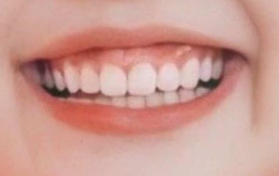 Best Zirconia Crown Dubai