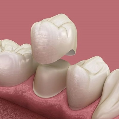 Best Zirconia Crown in Dubai - Dental Crowns