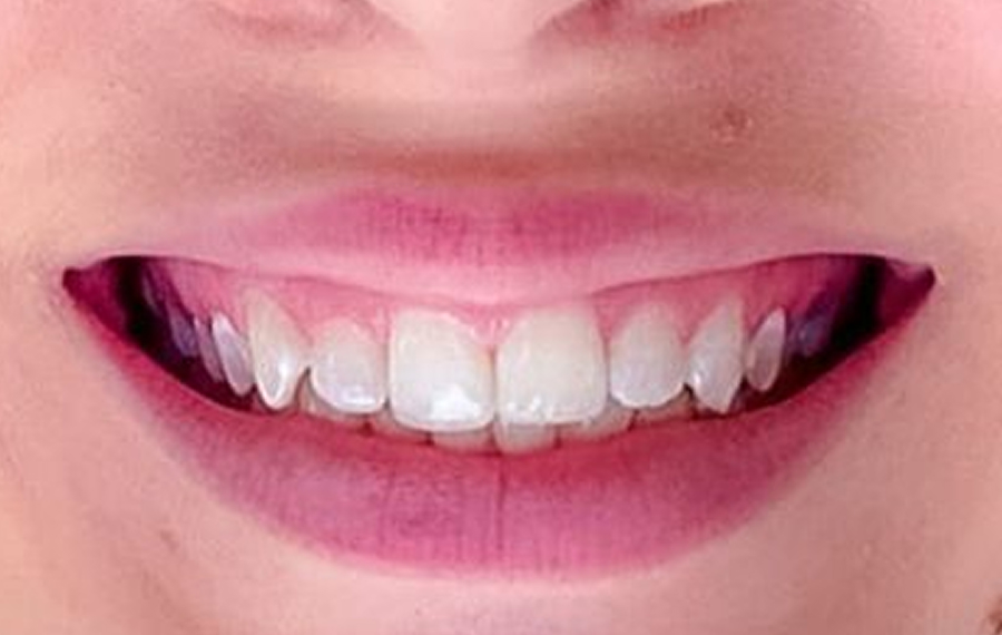 Best Zirconia Crown in Dubai