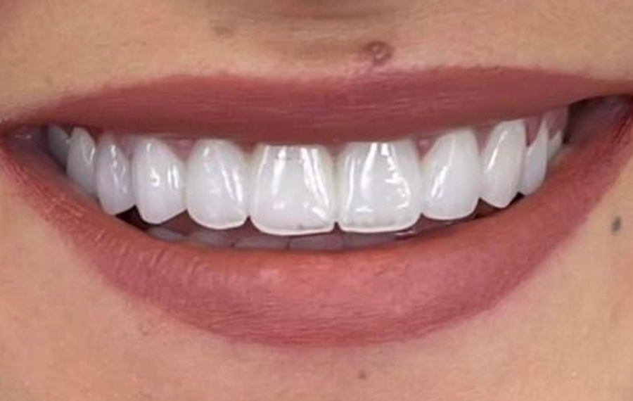 Best Zirconia Crown