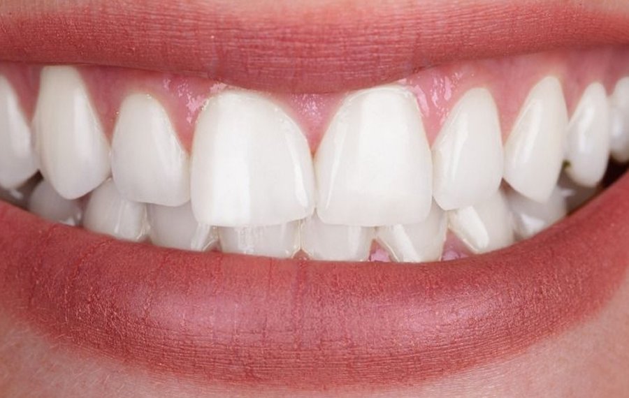 Best Zoom Teeth Whitening Dubai