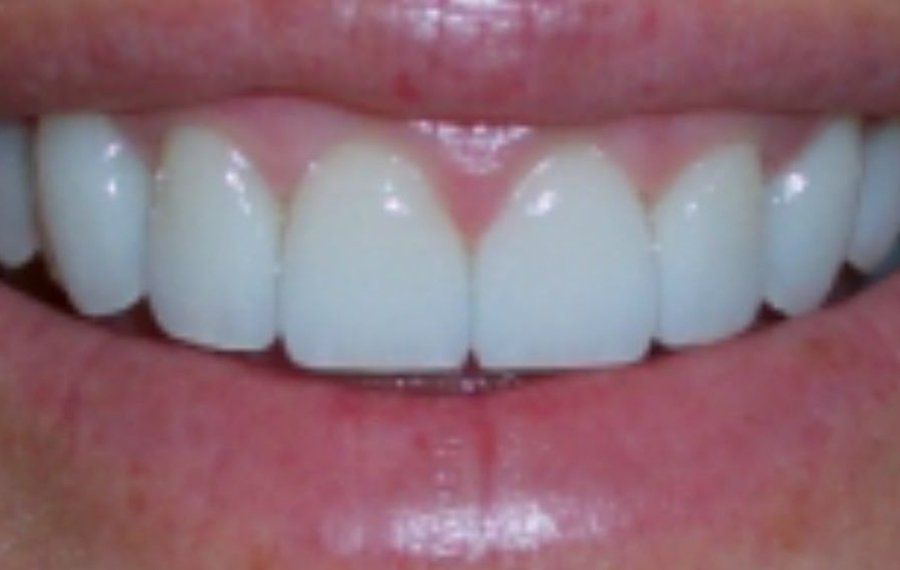 Best Zoom Teeth Whitening