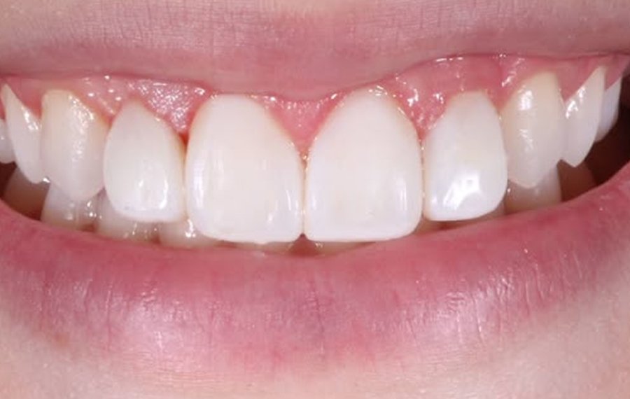 Composite Filling Dubai