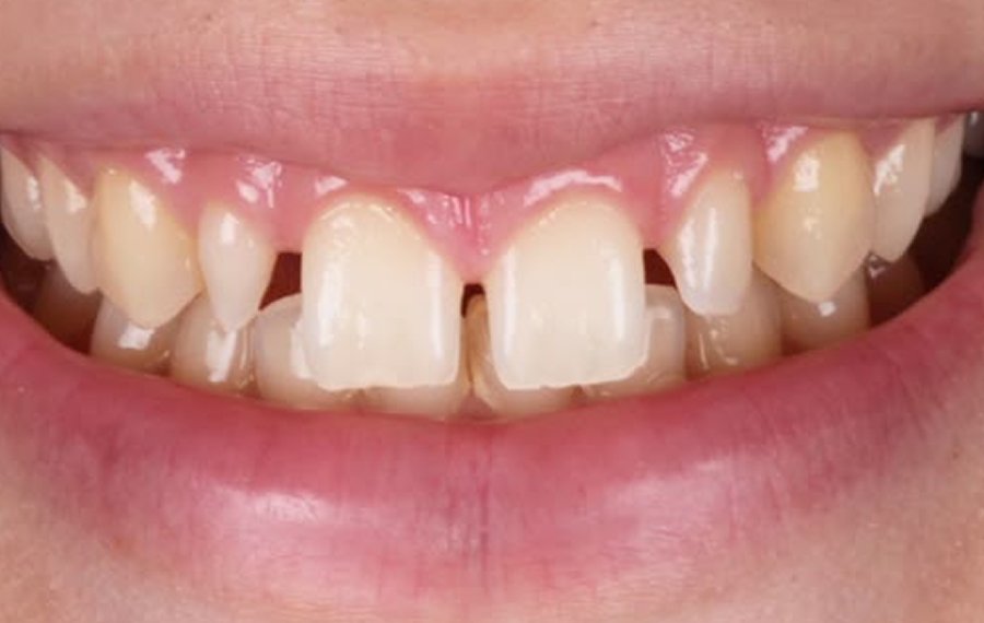 Composite Filling in Dubai