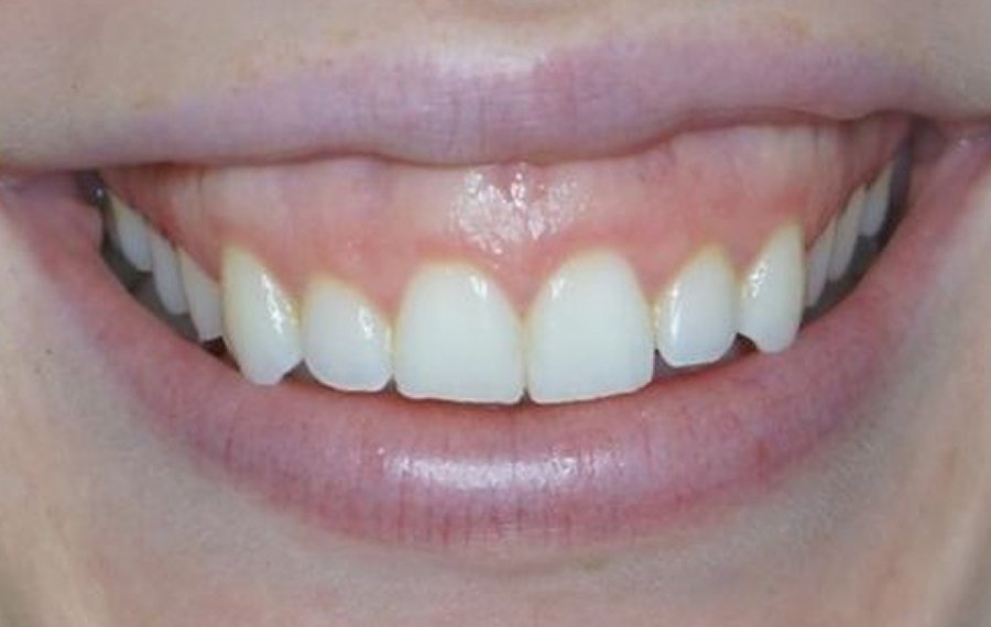 Composite Veneers in Dubai Composite Veneers in Dubai