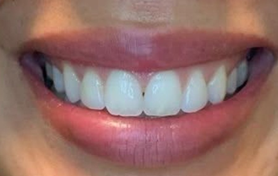Composite Veneers Composite Veneers