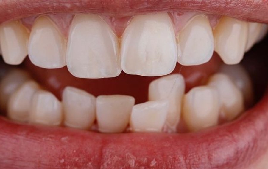 Crowded Teeth Treatment Dubai
