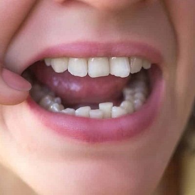 Crowded Teeth Treatment in Dubai - Best Dental Crowding