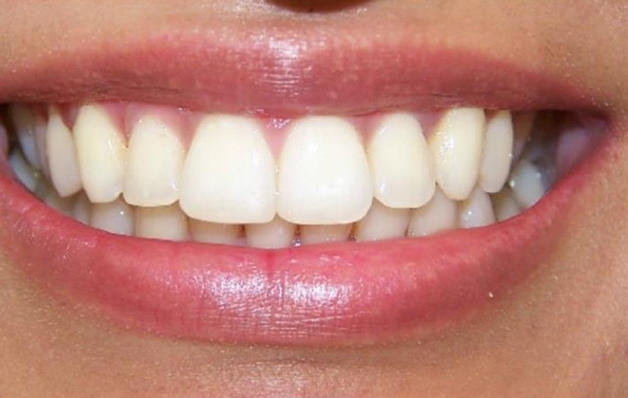 Crowded Teeth Treatment in Dubai