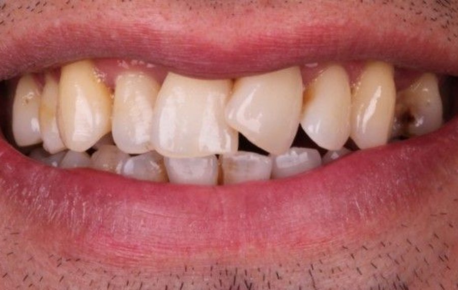 Crowded Teeth Treatment
