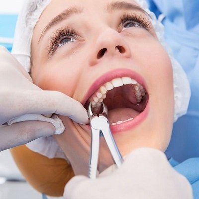 Dental Extraction in Dubai Best Tooth Extraction