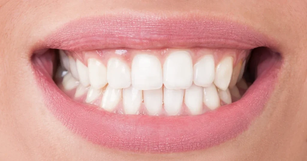 Dental Facts You Should Know About Teeth Whitening