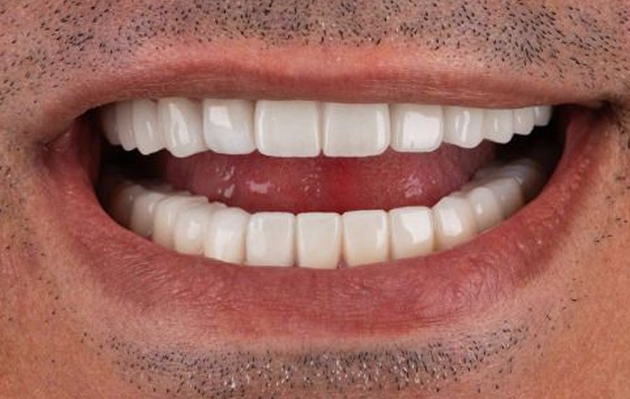 Dental Implant Infection Dubai Dental Implant Infection Dubai