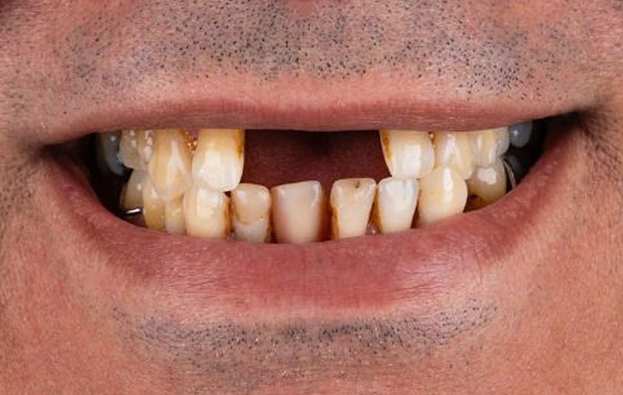 Dental Implant Infection Dental Implant Infection