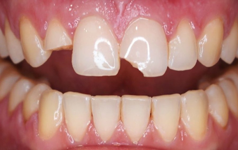 Dental Implants in Dubai