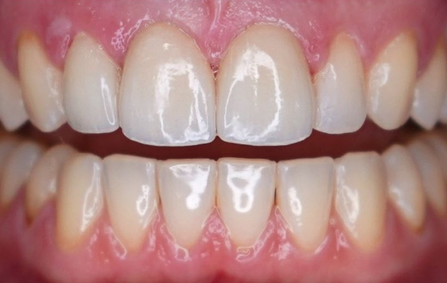 Dental Stains Removal Dental Stains Removal