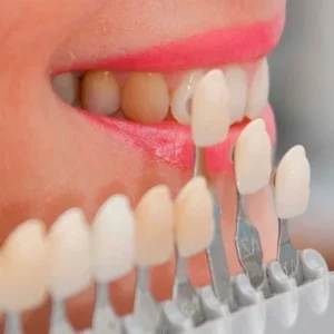 Dental Veneers Cost in Dubai - Best Veneers Dubai