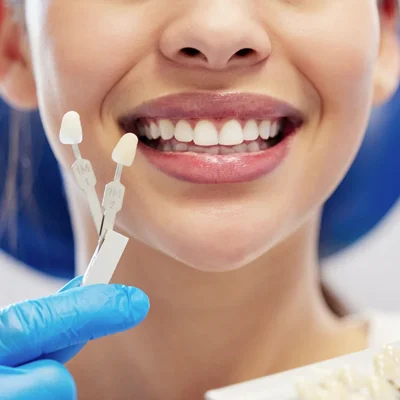 Dental-Veneers-in-Dubai-Best-Veneers-Clinic