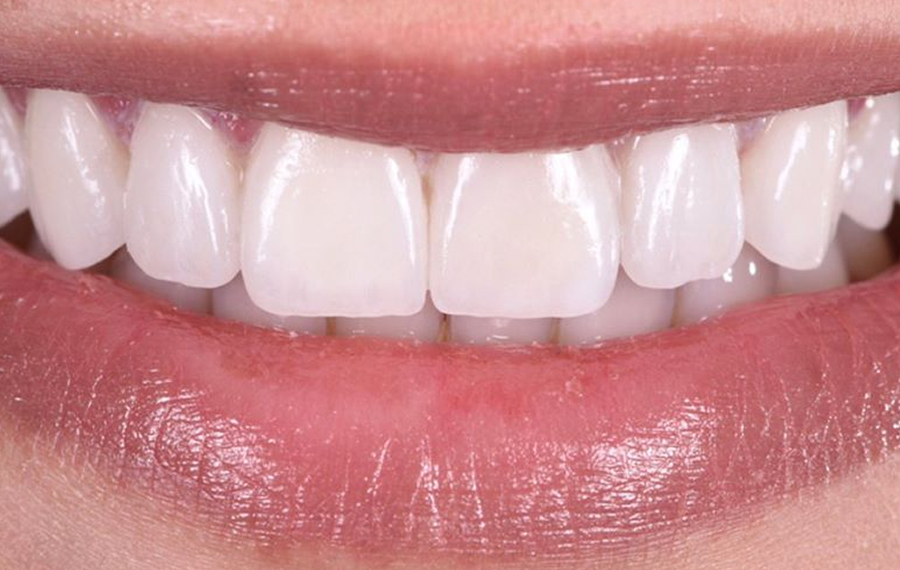Gingivectomy Dubai