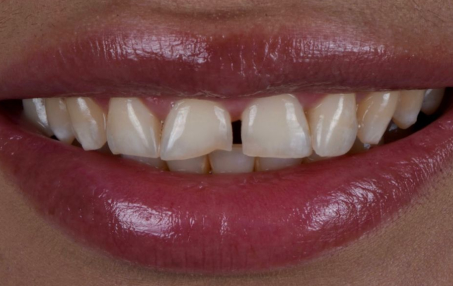 Gingivectomy Gingivectomy