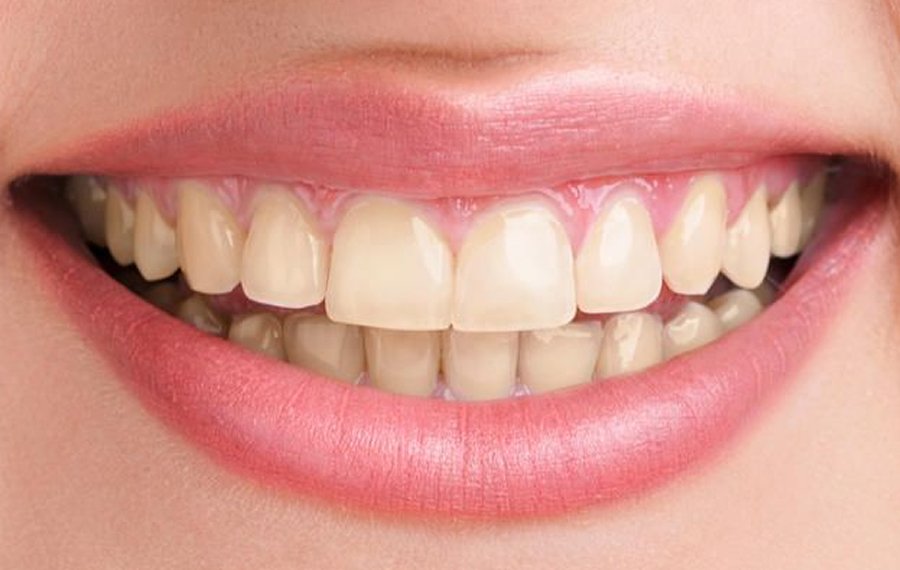 Hollywood Smile Design Dubai