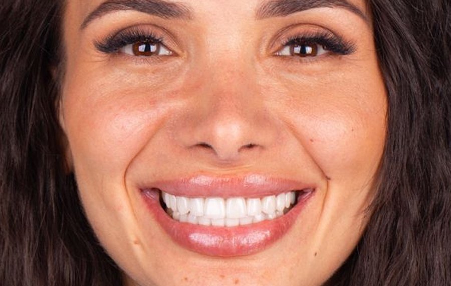 Hollywood Smile Design in Dubai