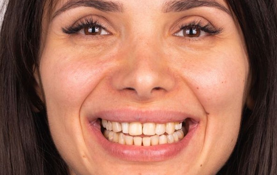 Hollywood Smile Design