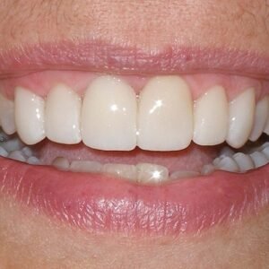 How Long Do Veneers Last on Front Teeth - Dental Veneers