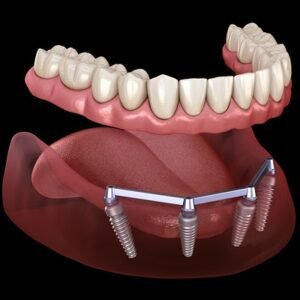 How Many Implants Are Needed For Full Mouth in Dubai Price