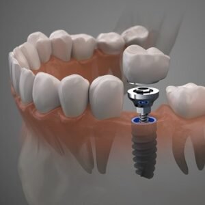 How Much Do Dental Implants Cost in Dubai