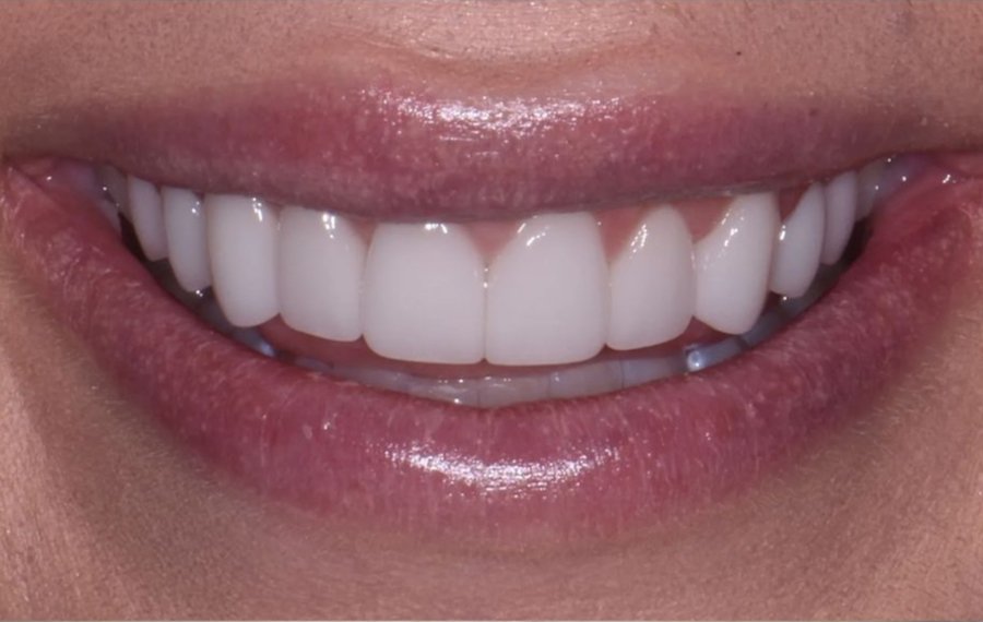 Lithium Disilicate Veneers Dubai