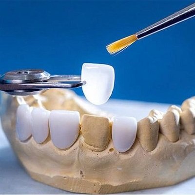 Lithium Disilicate Veneers in Dubai | Best E-Max Veneers