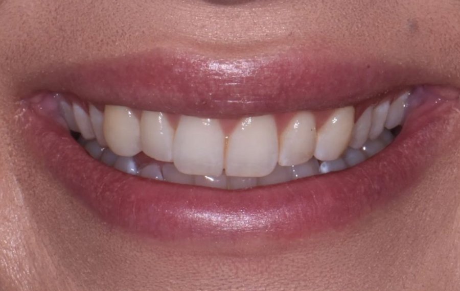 Lithium Disilicate Veneers in Dubai