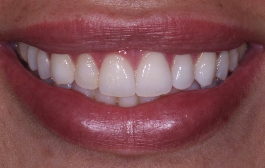 Lithium Disilicate Veneers