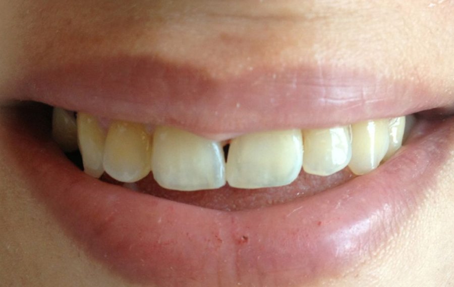 Mouthguards in Dubai 1