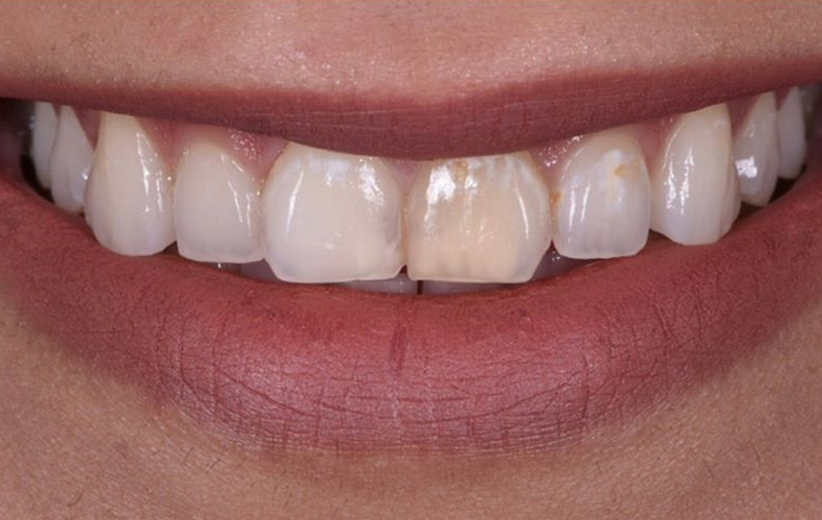 Nano Teeth Whitening Dubai Nano Teeth Whitening Dubai