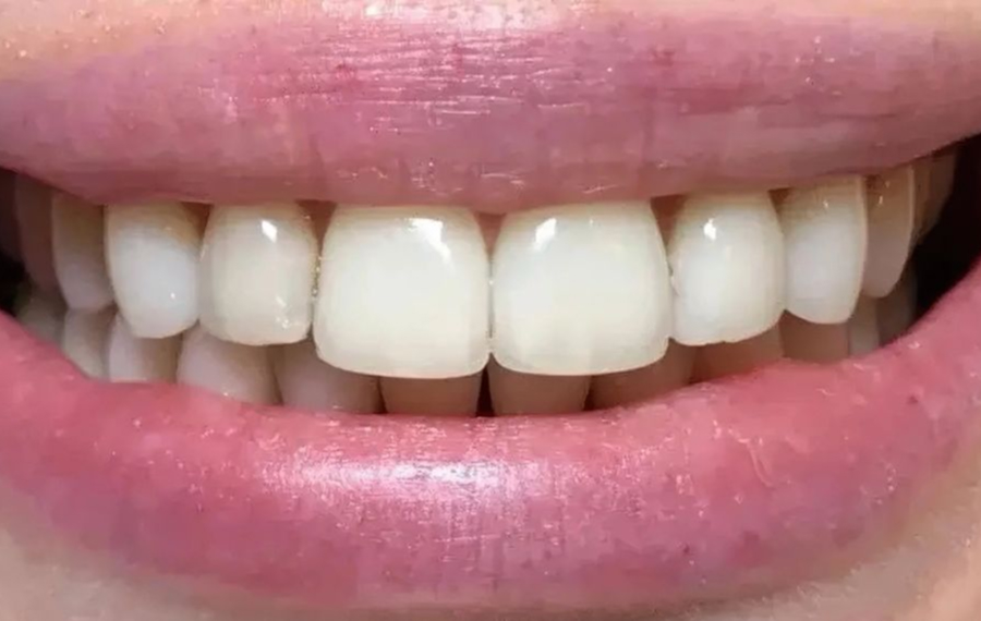 Nano Teeth Whitening in Dubai Nano Teeth Whitening in Dubai