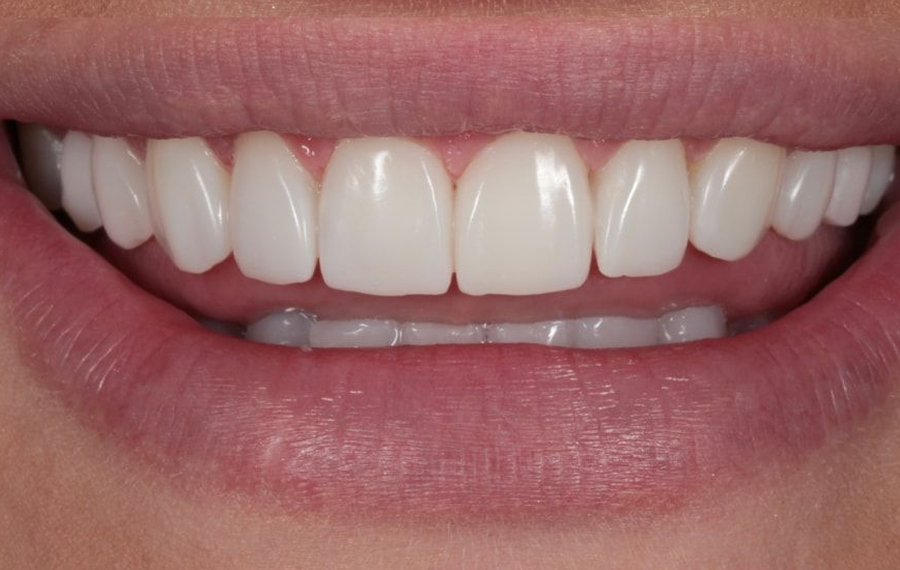 Nano Teeth Whitening