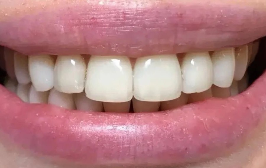 Nerve Filling With Inflammation in Dubai