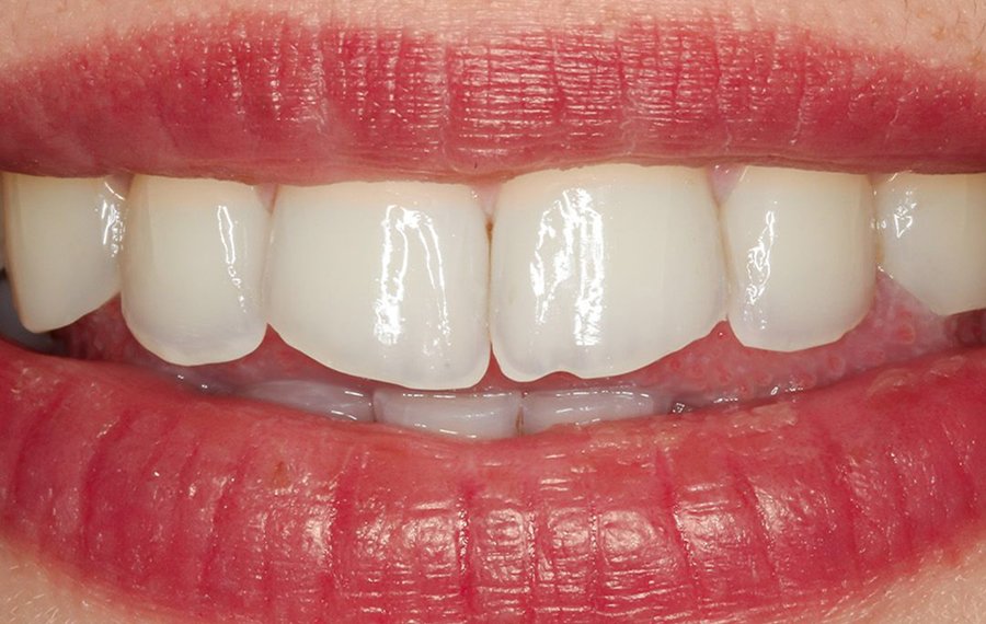 Posterior Root Canal Dubai