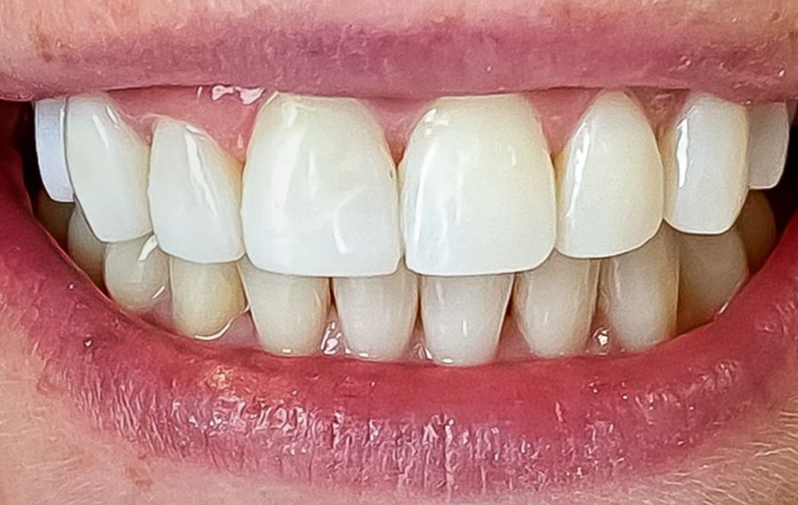 Posterior Root Canal in Dubai