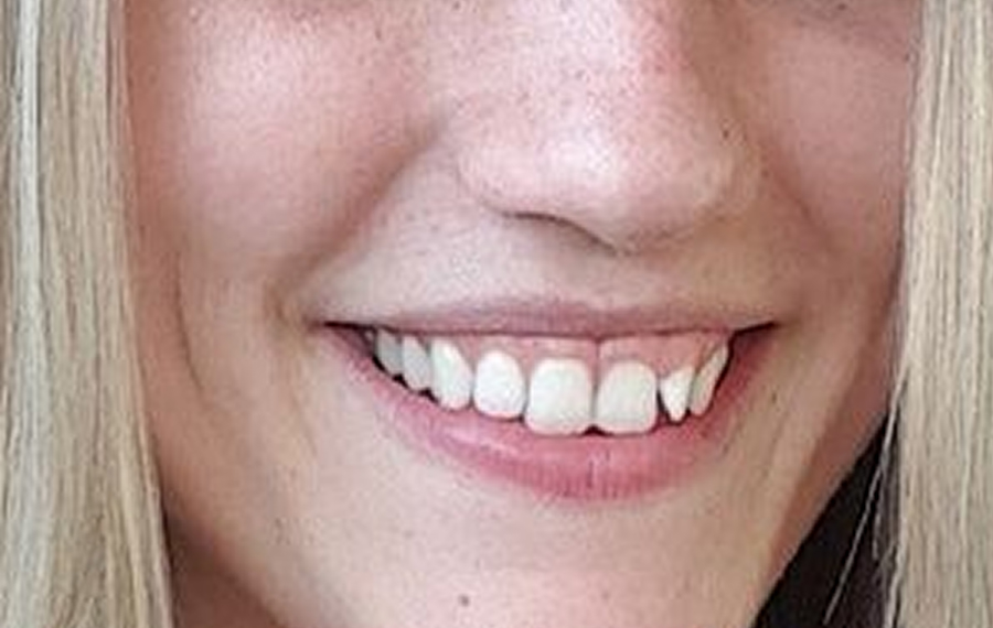 Root Canal Treatment Dubai Root Canal Treatment Dubai