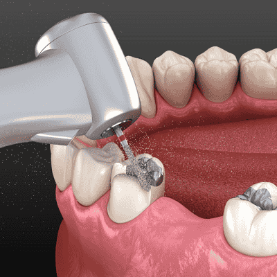 SMART – Dental Amalgam Removal in Dubai - Enfield Dental