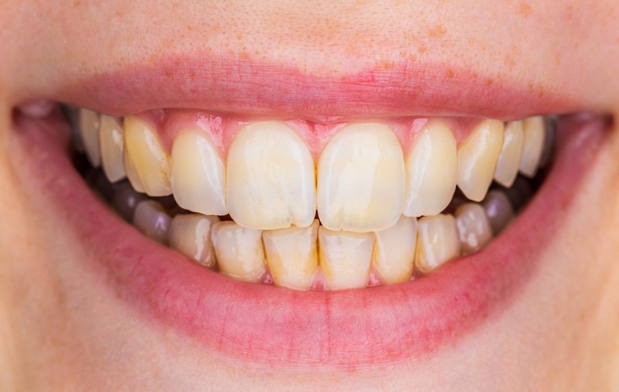 Teeth Cleaning Dubai Teeth Cleaning Dubai