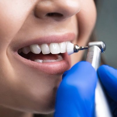 Teeth Cleaning in Dubai - Best Dental Cleaning