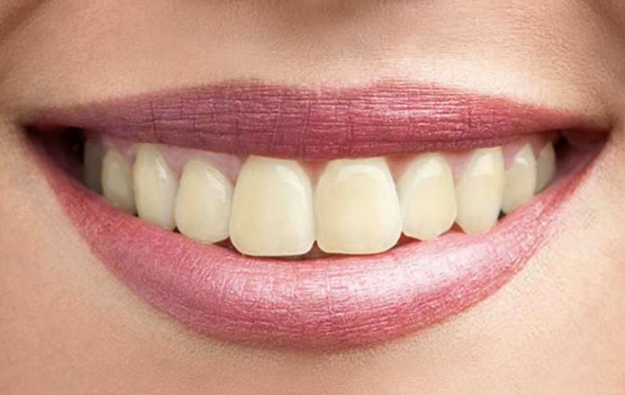 Teeth Cleaning Teeth Cleaning